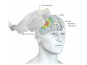 rTMS diagram